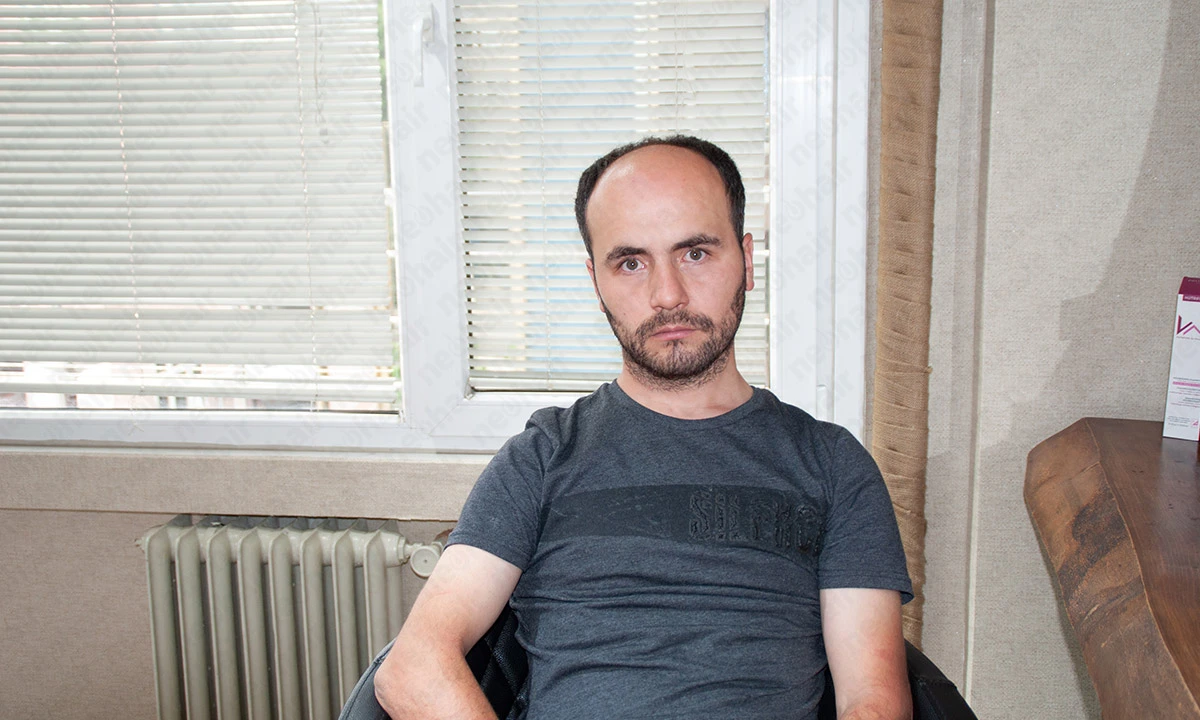 Protez Saçın Faydaları ve Kullanıcı Deneyimleri Protez saçın avantajları, doğal görünüm ve kullanım kolaylığı